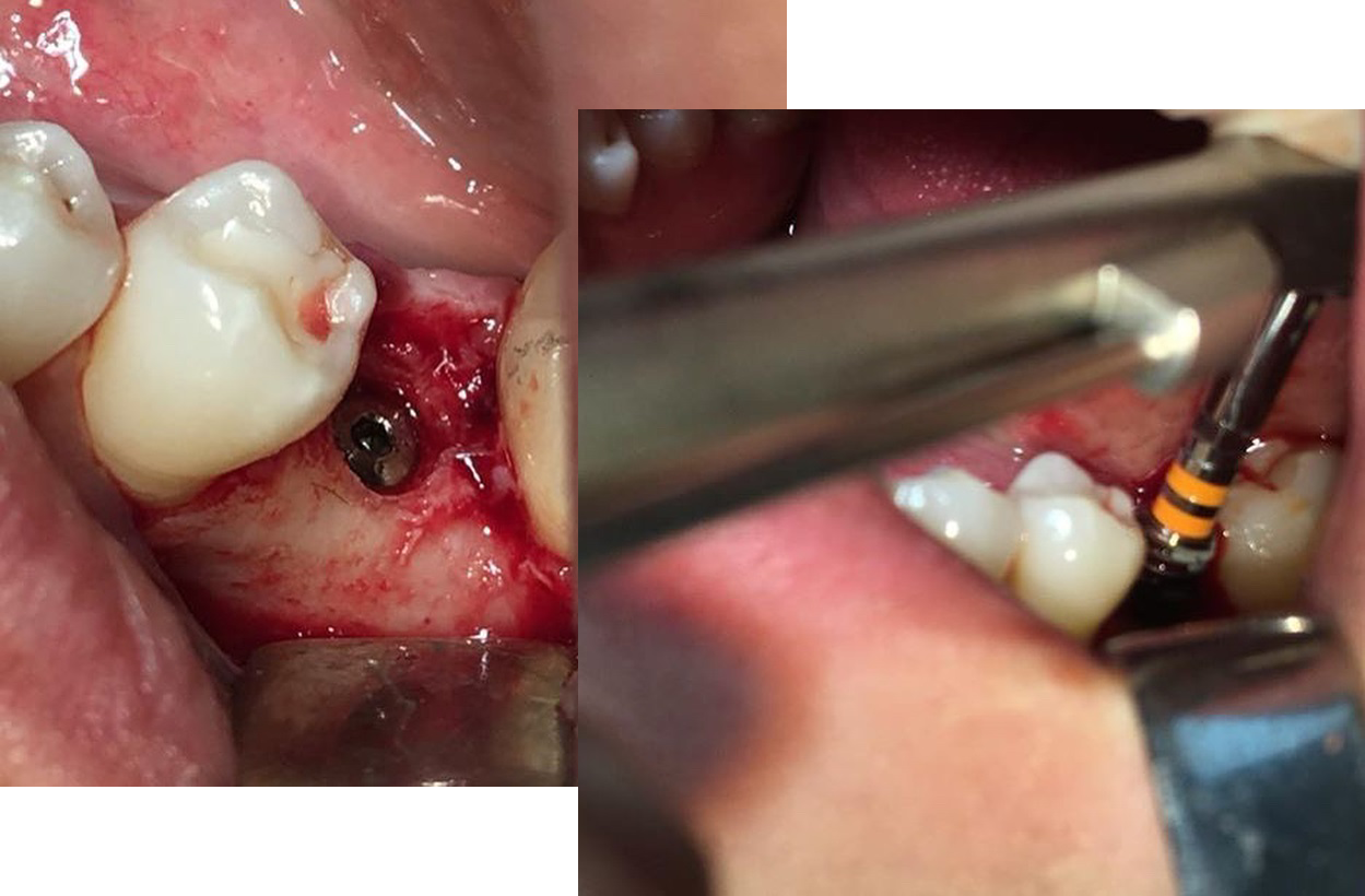 Implant-Dentar